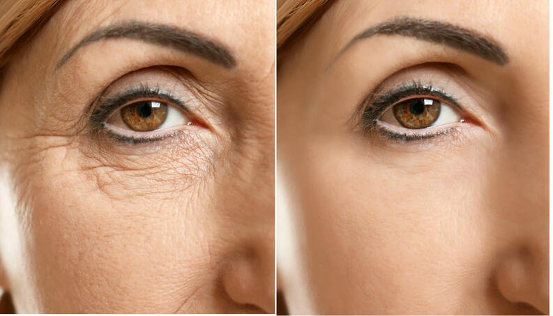 How to treat wrinkles under the eyes